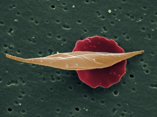 Rare medical cannabis trial set to begin in San Francisco. Pictured, a normal red blood cell versus a sickle cell