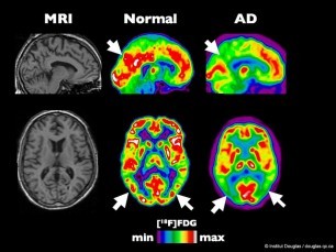 Alzheimers Disease includes reduced brain activity and function (red areas above), the result of years of accumulated damage. Molecules in pot seem to prevent this damage.